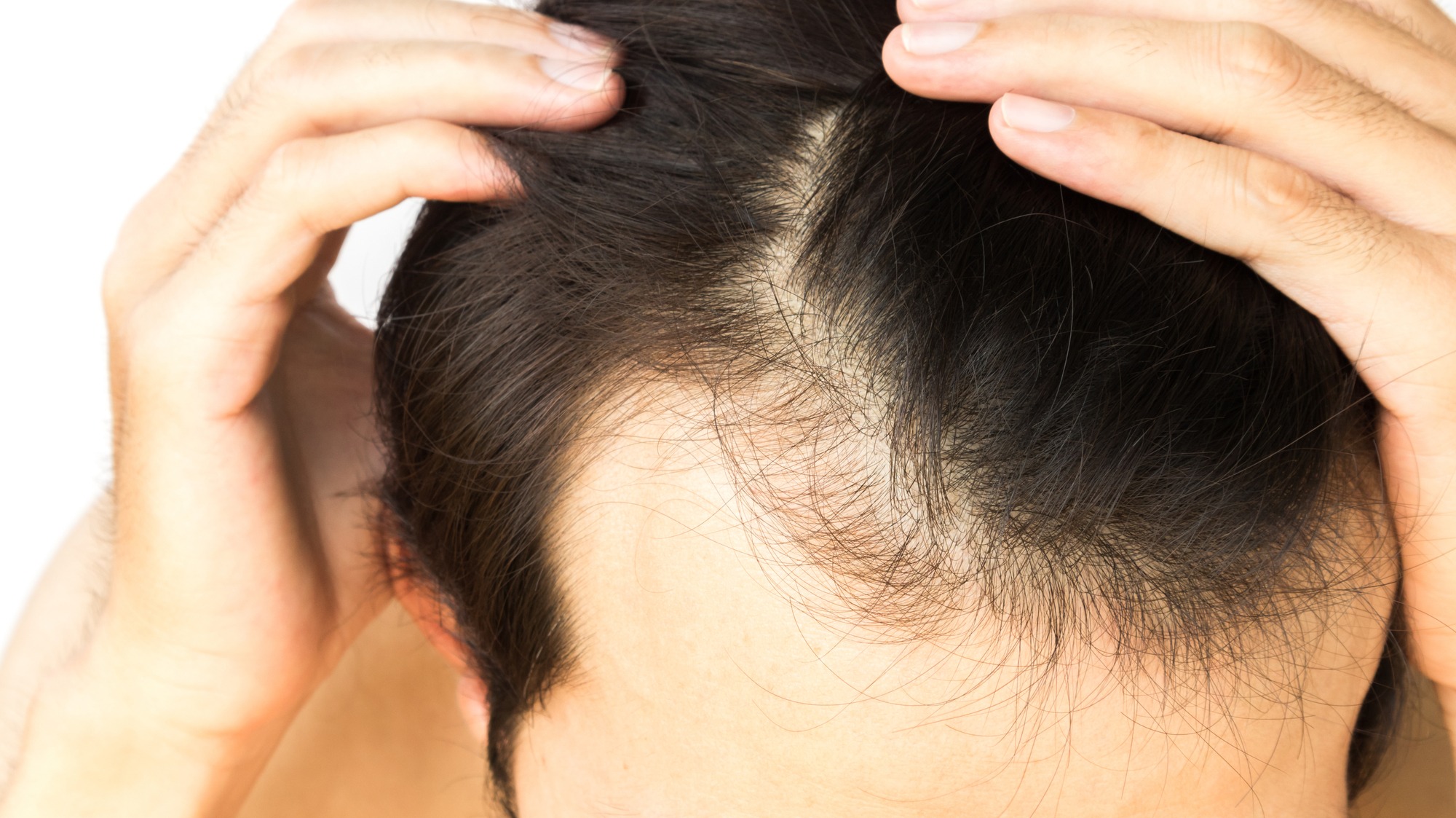 Concern over thinning hair is evident as a person examines a receding hairline, highlighting common issues related to hair loss.